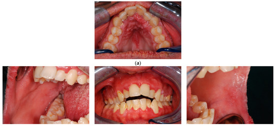 Biomedicines, Vol. 11, Pages 81: Gingival Overgrowths Revealing PTEN Hamartoma Tumor Syndrome: Report of Novel PTEN Pathogenic Variants
