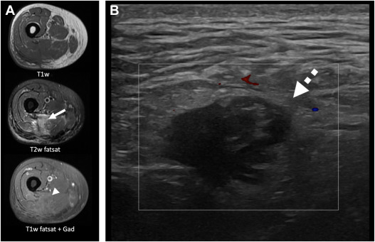Sarcoma Imaging Surveillance