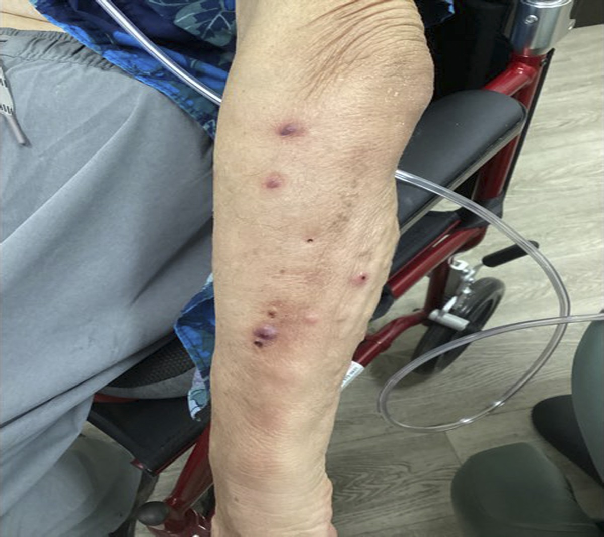 Erythematous Papules and Nodules on the Left Arm