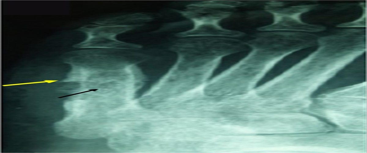 Tuberculous Osteomyelitis of the Fifth Metatarsal Treated Using the Induced Membrane Technique: A Case Report