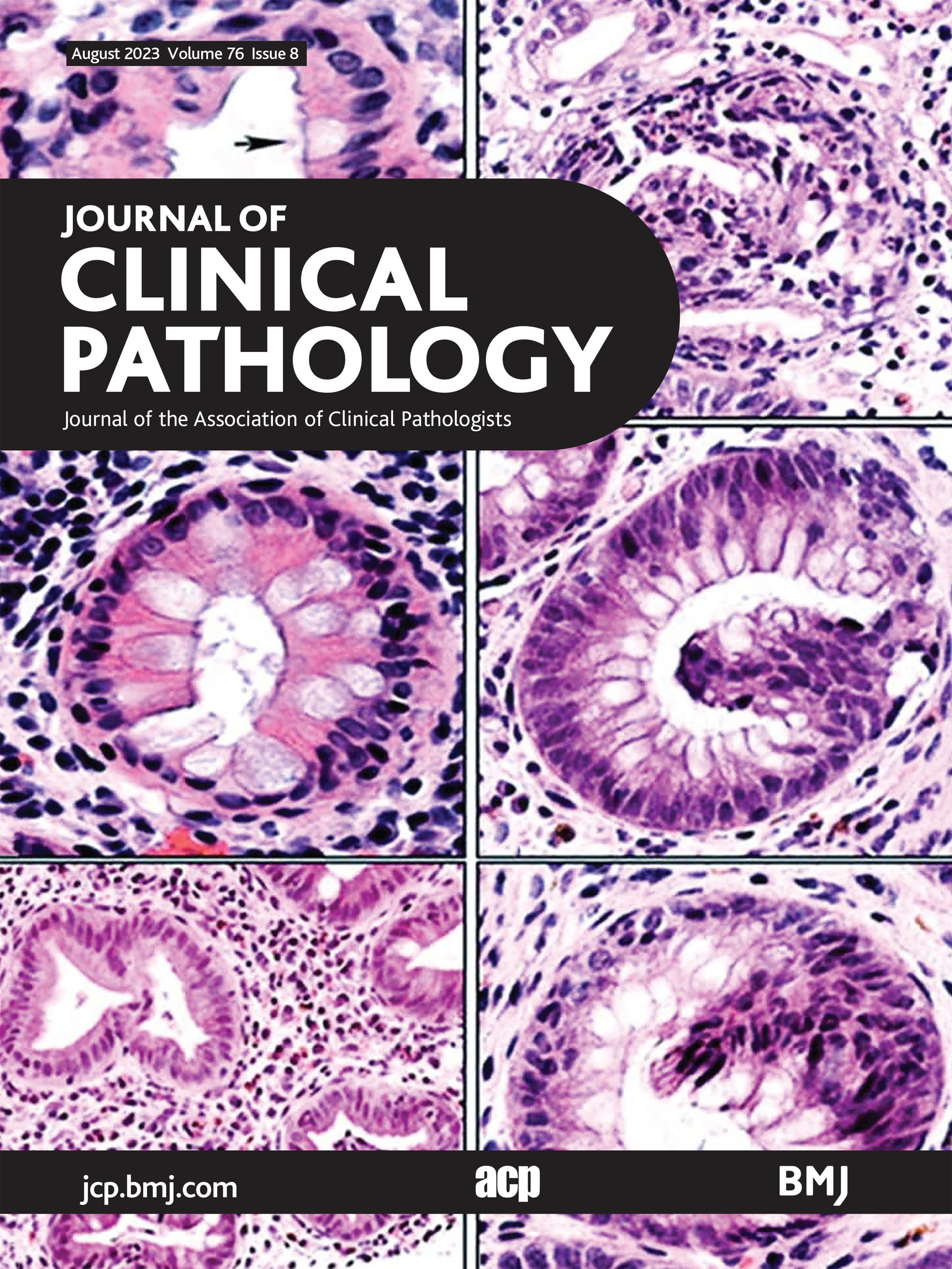 Overexpression of integrin alpha 2 (ITGA2) correlates with poor survival in patients with pancreatic ductal adenocarcinoma