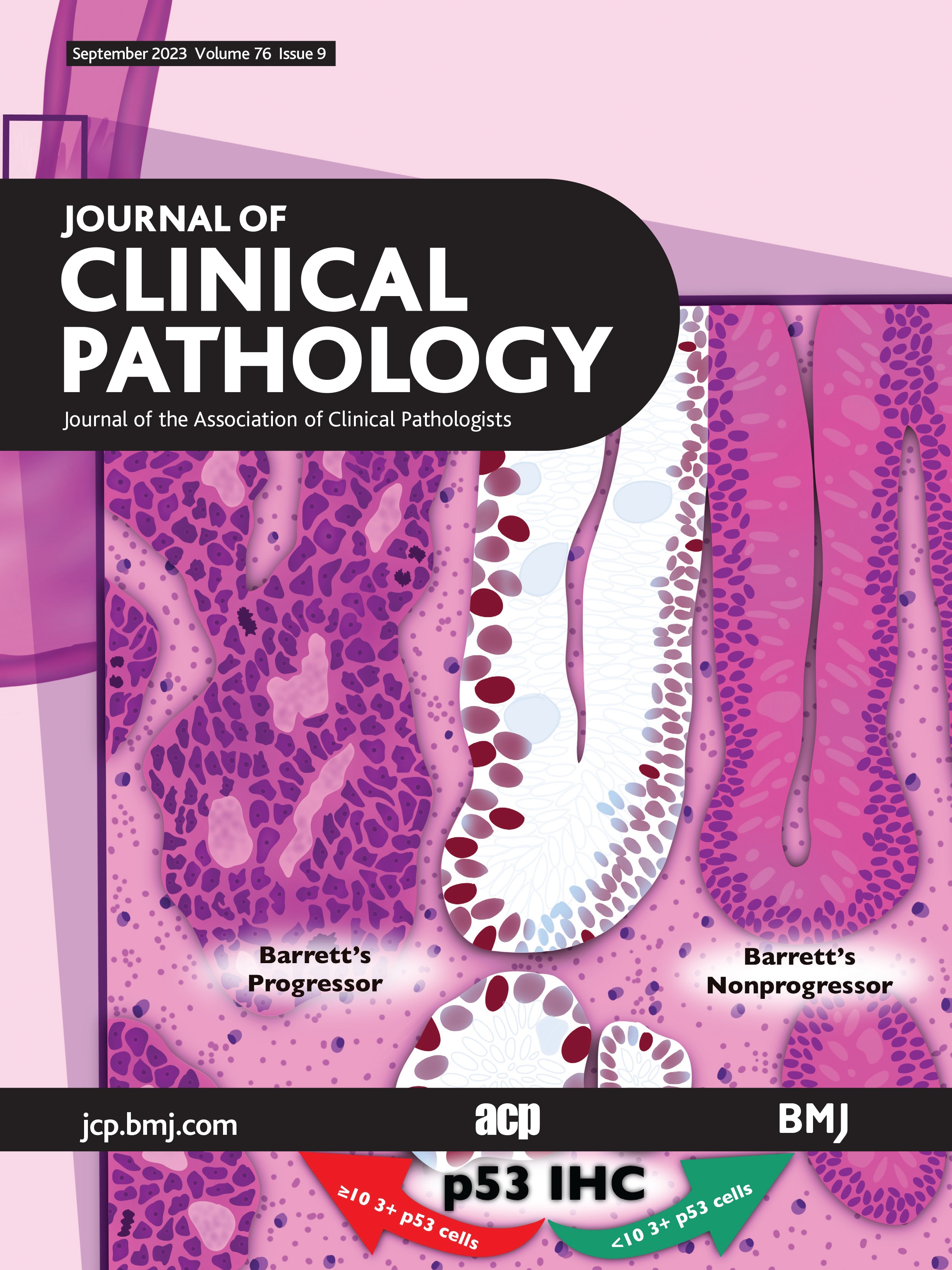 Unravelling the USP6 gene: an update