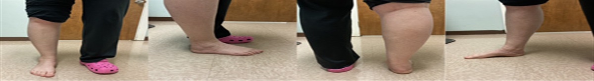 Approach for Neglected Calcaneal Fracture-Dislocation and Associated Complications