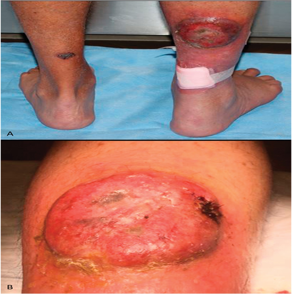 A Rare Case of Primary Cutaneous Gamma-Delta T-cell Lymphoma with Aberrant B-cell Marker Expression