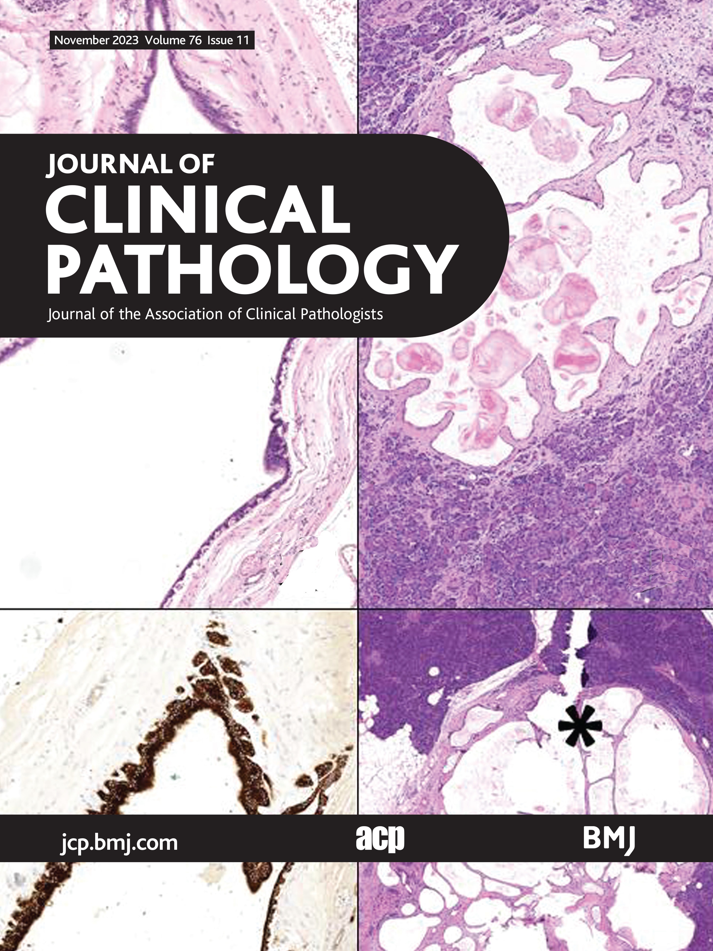 Performance evaluation and clinical impact of the Oncomine Myeloid Research Assay for gene expression analysis in myeloid haematologic malignancies