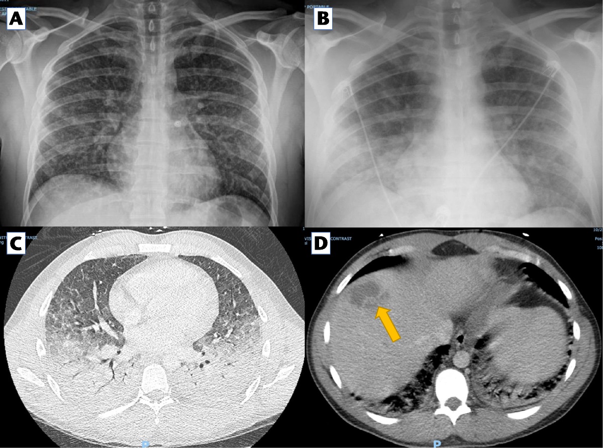 Liver Abscesses Due to Fusobacterium nucleatum: A Case Series