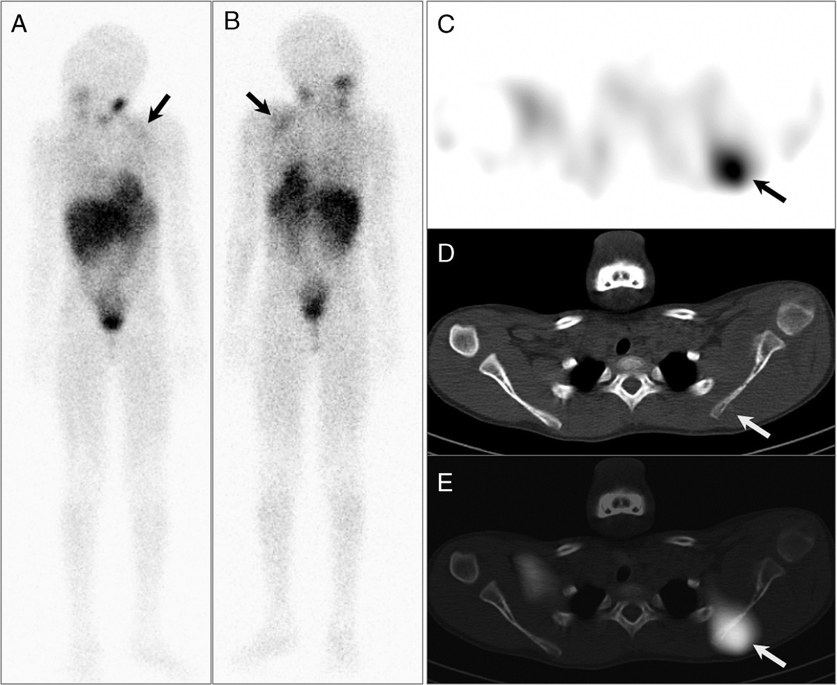 Solitary Neuroblastoma in the Scapula