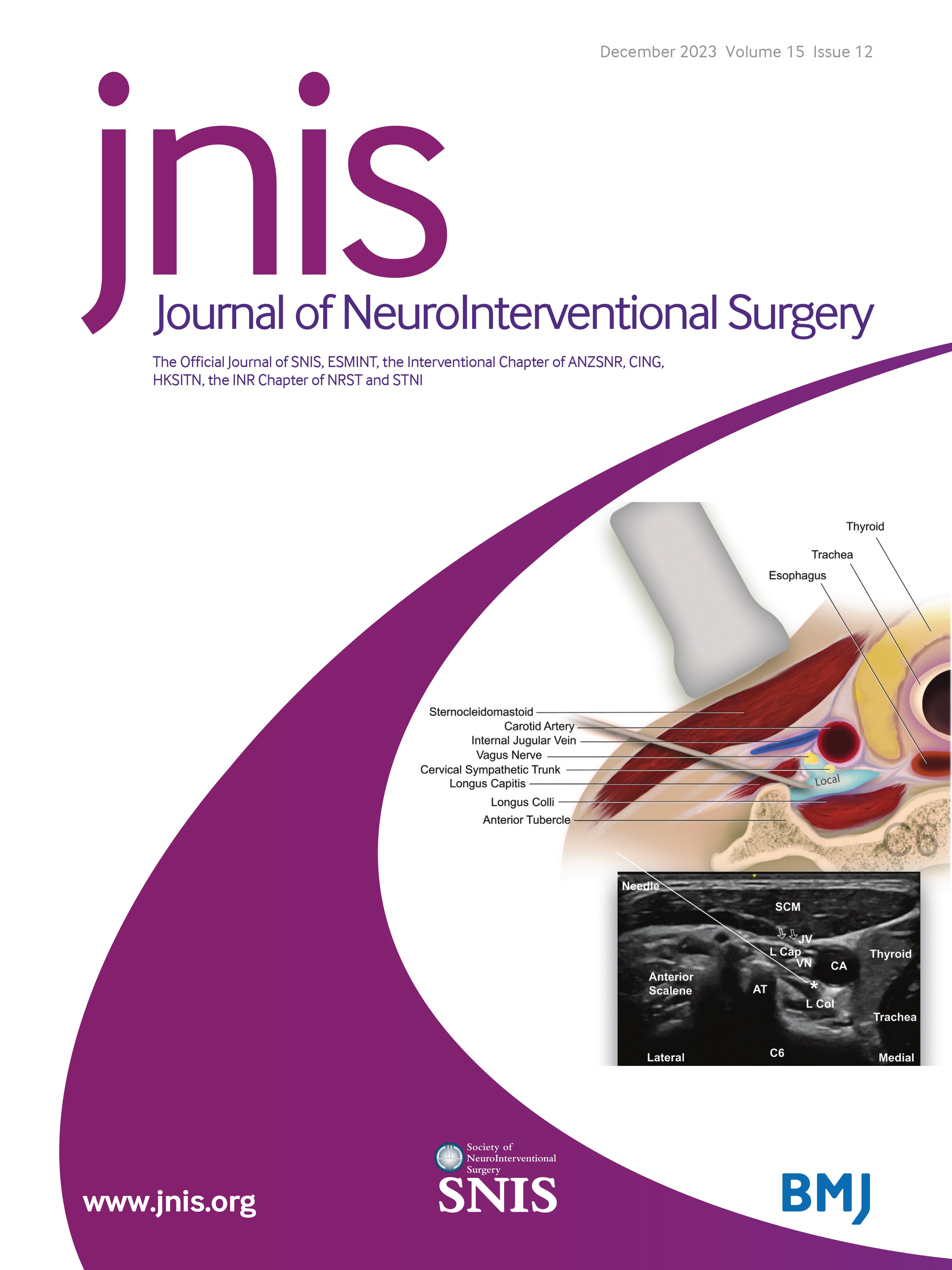 CT hyperdense cerebral artery sign reflects distinct proteomic composition in acute ischemic stroke thrombus