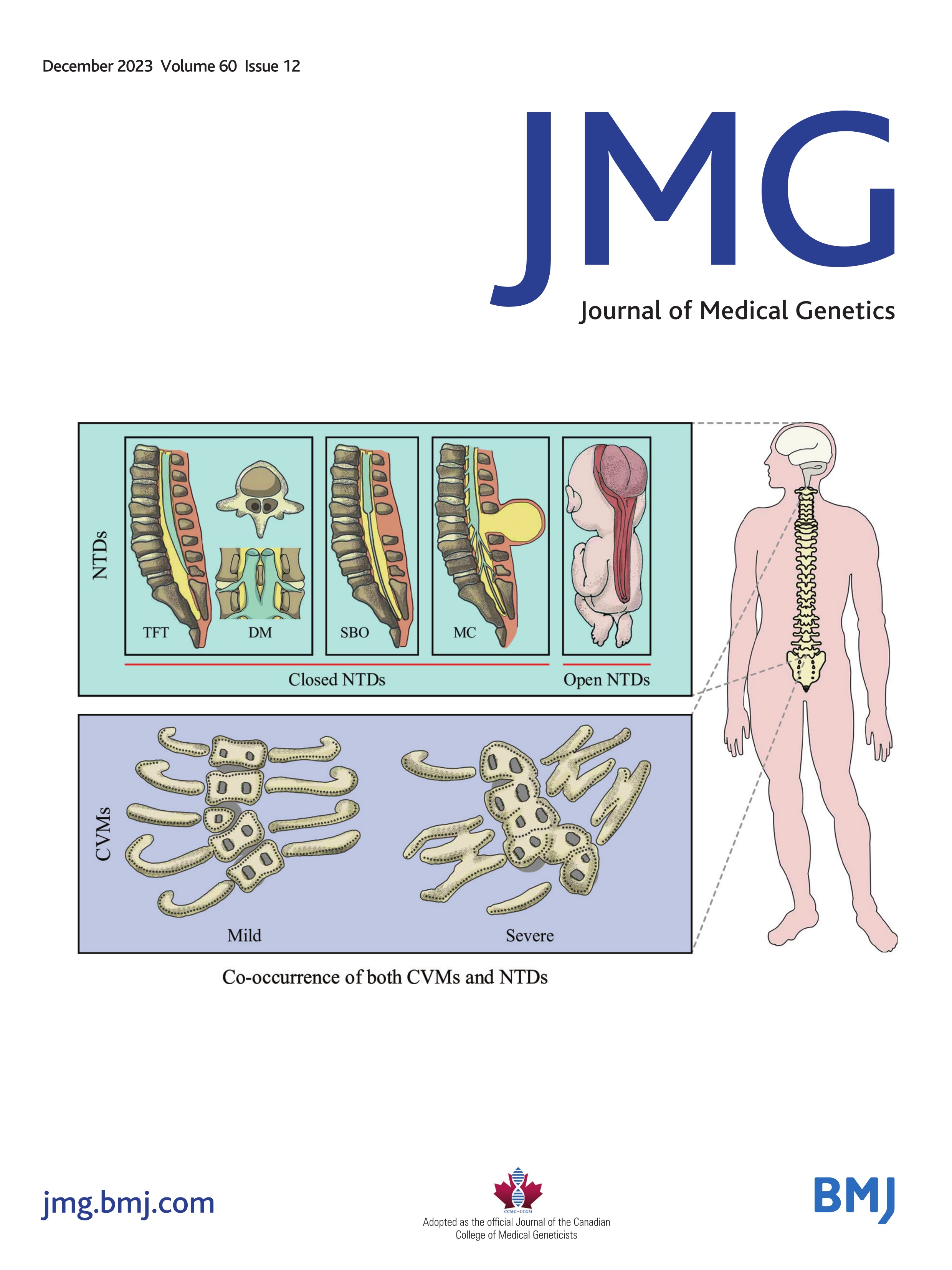 The Phenotypic variability of 16p11.2 distal BP2-BP3 deletion in a transgenerational family and in neurodevelopmentally ascertained samples