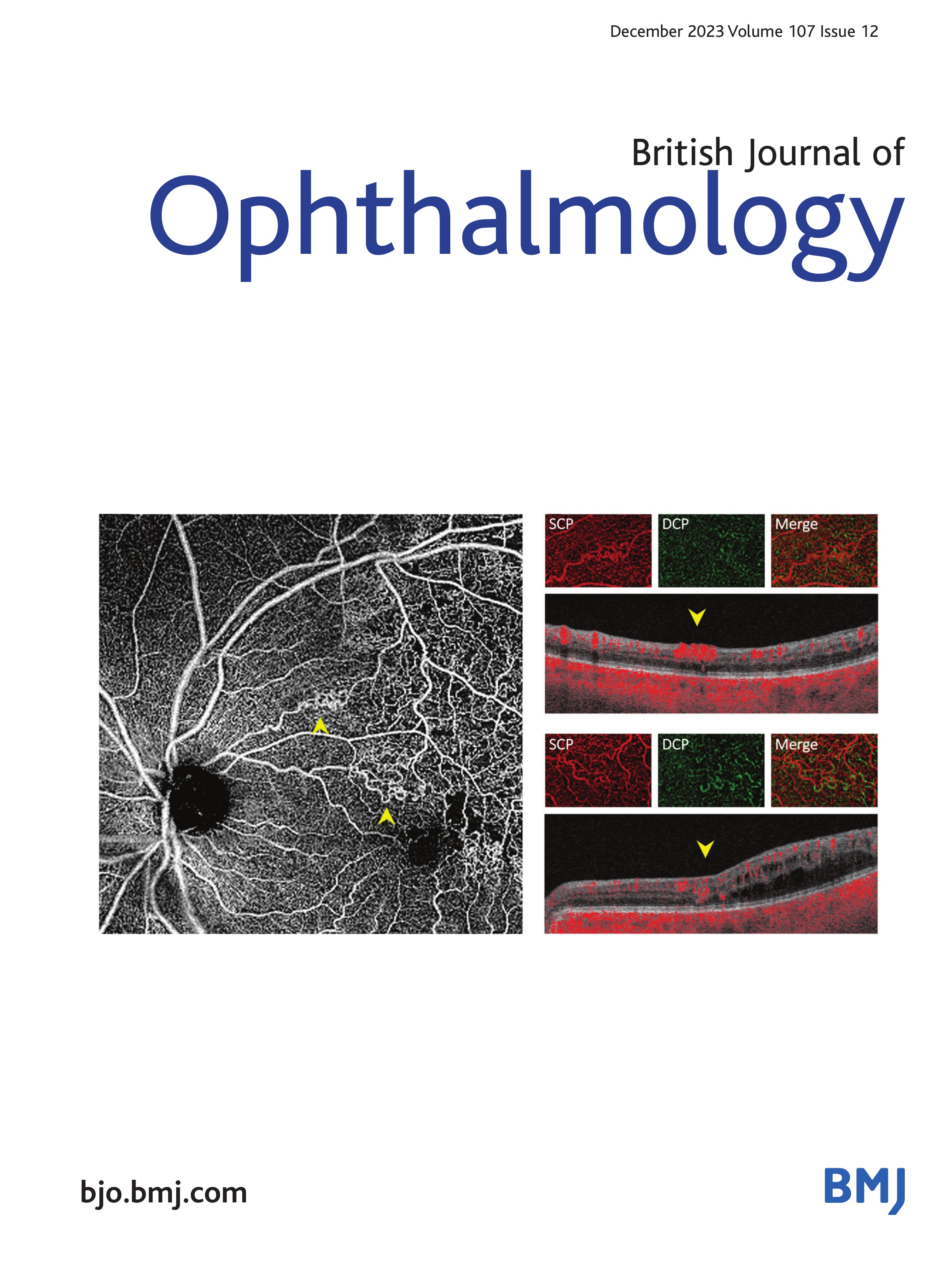 Hypotony in uveitis: an overview of medical and surgical management